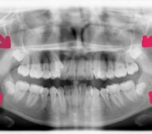 X-ray of teeth showing wisdom teeth needed to be extracted